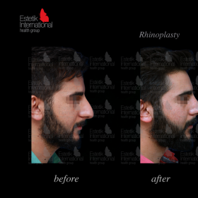 Rhinoplasty (nose job) Before & After Photos in Estetik International