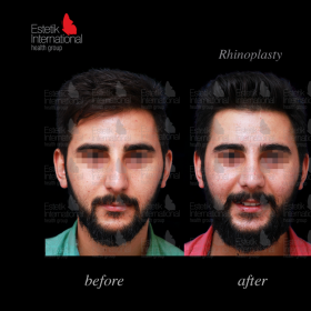 Rhinoplasty (nose job) Before & After Photos in Estetik International