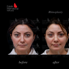Rhinoplasty (nose job) Before & After Photos in Estetik International