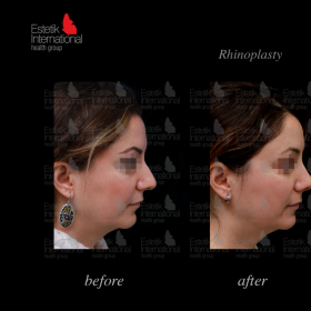 Rhinoplasty (nose job) Before & After Photos in Estetik International