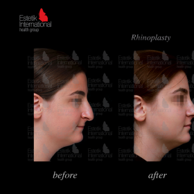 Rhinoplasty (nose job) Before & After Photos in Estetik International