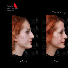 Rhinoplasty (nose job) Before & After Photos in Estetik International