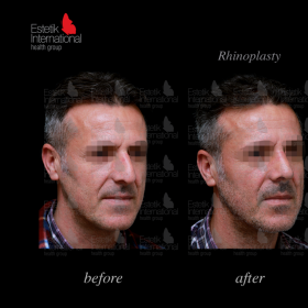 Rhinoplasty (nose job) Before & After Photos in Estetik International