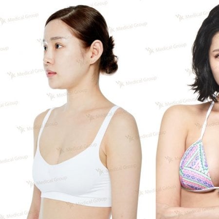 نتائج قبل وبعد تكبير الثدي في JK Plastic Surgery Center، زيادة حجم الصدر