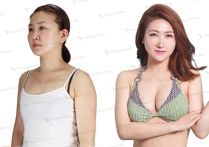 Результаты до и после увеличения груди в JK Plastic Surgery Center, увеличенный бюст