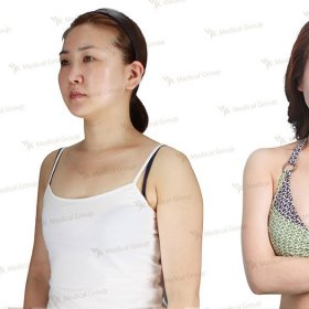 Breast augmentation Before & After Photos in JK Plastic Surgery Center