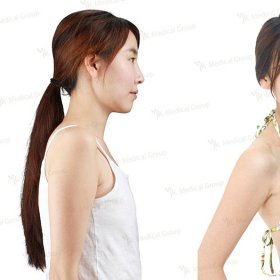 Breast augmentation Before & After Photos in JK Plastic Surgery Center