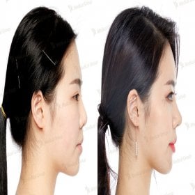 Rhinoplasty (nose job) Before & After Photos in JK Plastic Surgery Center