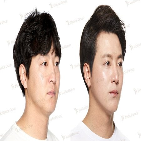 نتائج عملية تجميل الأنف قبل وبعد في JK Plastic Surgery Center، تحسين شكل الأنف