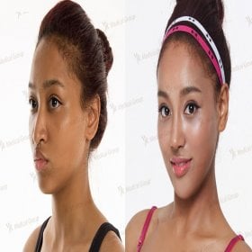 Rhinoplasty (nose job) Before & After Photos in JK Plastic Surgery Center