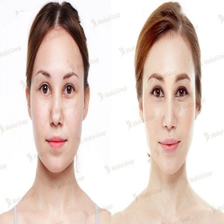 نتائج تجميل الأنف قبل وبعد في مركز JK لجراحة التجميل، تحسين شكل الأنف