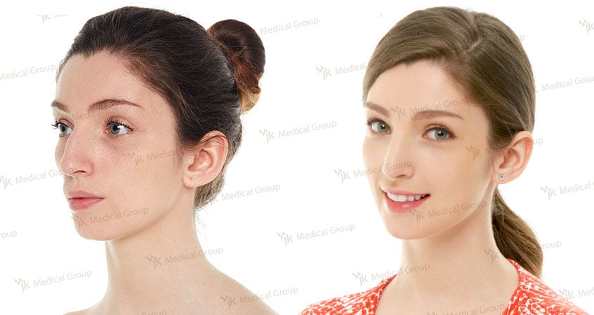 Результаты ринопластики до и после в JK Plastic Surgery Center, улучшенная форма носа