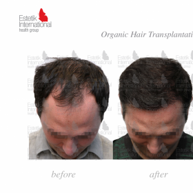 FUE hair transplant Before & After Photos in Estetik International