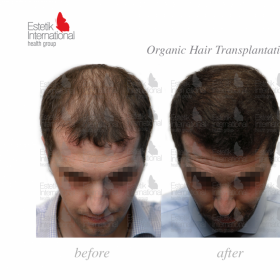 FUE hair transplant Before & After Photos in Estetik International