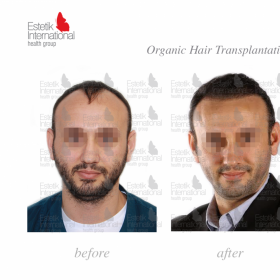 FUE hair transplant Before & After Photos in Estetik International