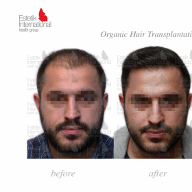 FUE hair transplant Before & After Photos in Estetik International