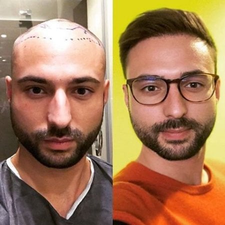 Результати пересадки волосся FUE до і після в Istanbul Aesthetic Plastic Surgery Center