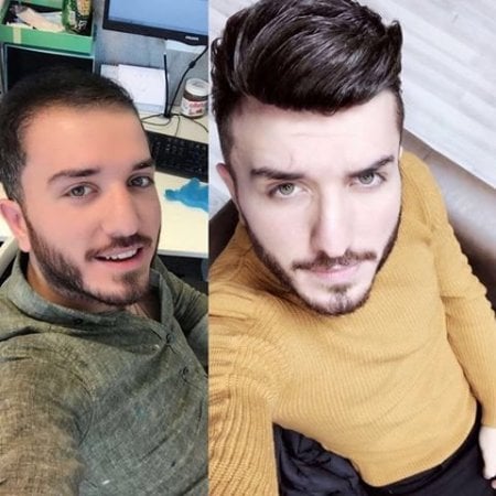 نتائج قبل وبعد زراعة الشعر FUE في مركز إسطنبول لجراحة التجميل