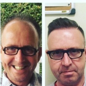 FUE hair transplant Before & After Photos in Istanbul Aesthetic Plastic Surgery Center