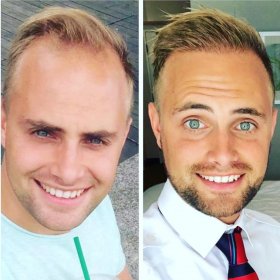 FUE hair transplant Before & After Photos in Istanbul Aesthetic Plastic Surgery Center