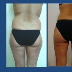 Liposuction Before & After Photos in Istanbul Aesthetic Plastic Surgery Center
