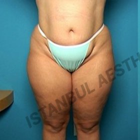 Liposuction Before & After Photos in Istanbul Aesthetic Plastic Surgery Center