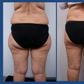 Liposuction Before & After Photos in Istanbul Aesthetic Plastic Surgery Center