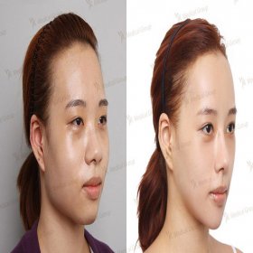 Blepharoplasty (Eyelid correction) Before & After Photos in JK Plastic Surgery Center
