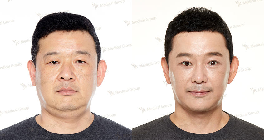 نتائج رأب الجفن قبل وبعد في JK Plastic Surgery Center، تصحيح الجفون