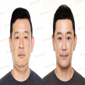 Blepharoplasty (Eyelid correction) Before & After Photos in JK Plastic Surgery Center