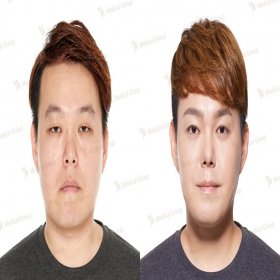 Blepharoplasty (Eyelid correction) Before & After Photos in JK Plastic Surgery Center