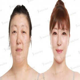Blepharoplasty (Eyelid correction) Before & After Photos in JK Plastic Surgery Center