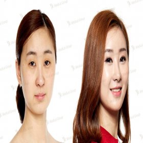 Blepharoplasty (Eyelid correction) Before & After Photos in JK Plastic Surgery Center
