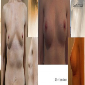 Breast augmentation Before & After Photos in FORME Clinic