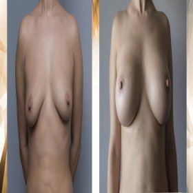 Breast augmentation Before & After Photos in FORME Clinic