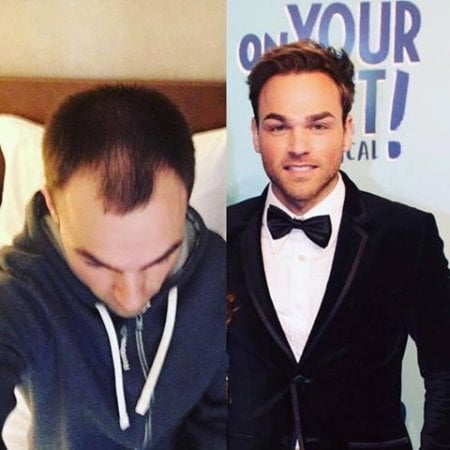 Before and after hair transplant results at Istanbul Aesthetic Plastic Surgery Center, fuller hair