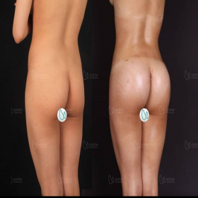 Brazilian Butt lift Before & After Photos in Estetik International