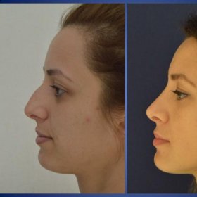 Rhinoplasty (nose job) Before & After Photos in Istanbul Aesthetic Plastic Surgery Center
