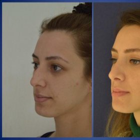 Rhinoplasty (nose job) Before & After Photos in Istanbul Aesthetic Plastic Surgery Center