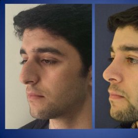 Rhinoplasty (nose job) Before & After Photos in Istanbul Aesthetic Plastic Surgery Center