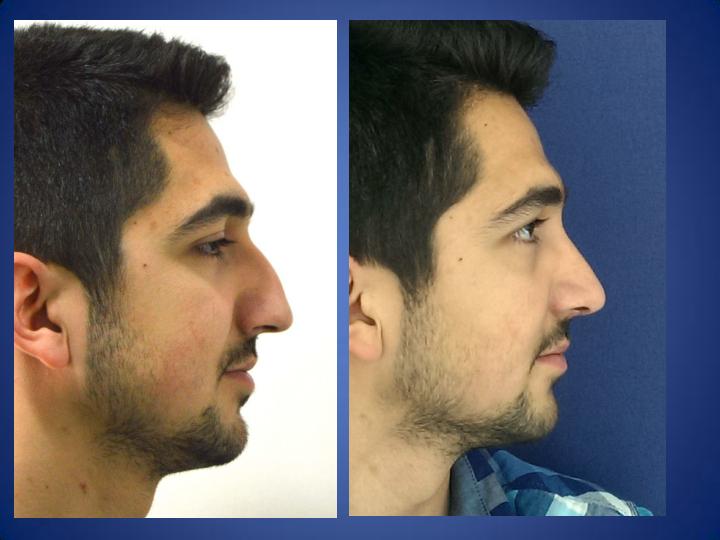cheapest rhinoplasty cheapest rhinoplasty