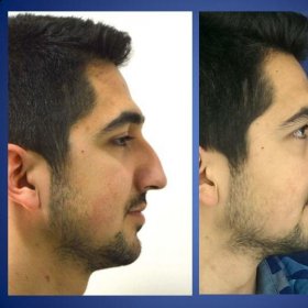 Rhinoplasty (nose job) Before & After Photos in Istanbul Aesthetic Plastic Surgery Center