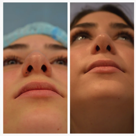 Resultados de rinoplastia antes y después en Dr. Arturo Muñoz Meza Plastic Surgery, remodelación nasal