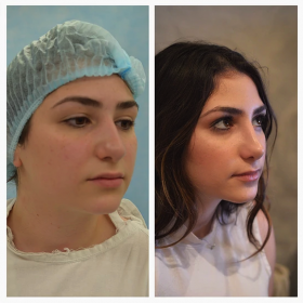 Resultados de rinoplastia antes y después en Dr. Arturo Muñoz Meza Plastic Surgery, remodelación nasal