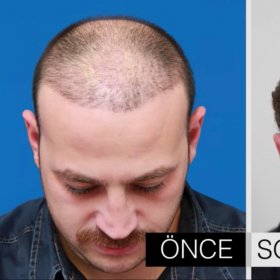 Hair transplant Before & After Photos in Estetik International