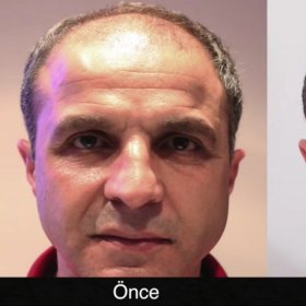 Hair transplant Before & After Photos in Estetik International