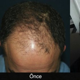 Hair transplant Before & After Photos in Estetik International