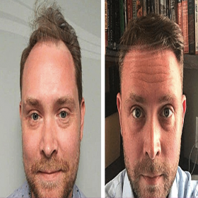 Resultados antes y después de trasplante capilar en Proesthe Hair Transplant Center, línea mejorada