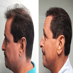 نتائج قبل وبعد زراعة الشعر في مركز Proesthe، كثافة شعر محسنة