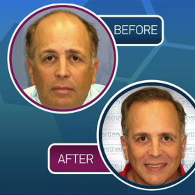 Resultados de trasplante capilar antes y después en Proesthe Hair Transplant Center, línea restaurada